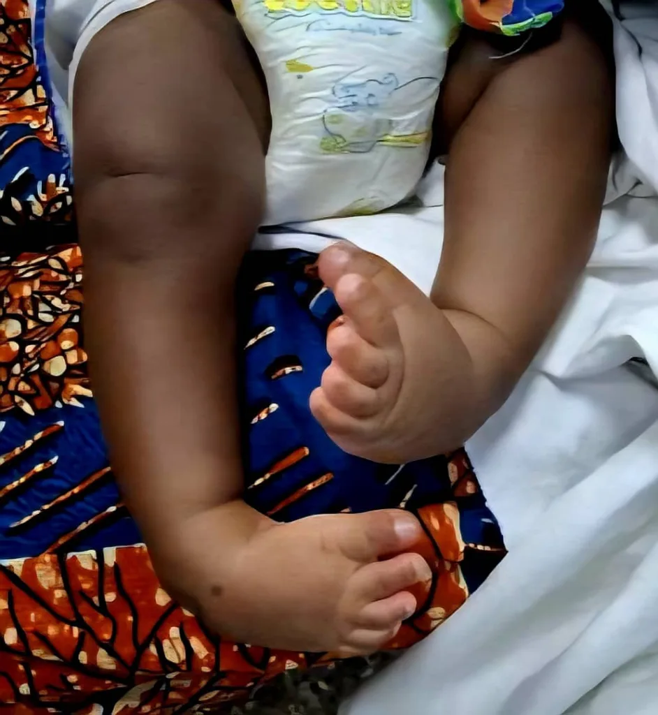 They were born with twisted feet. They learned to walk