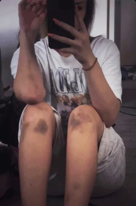 A selfie of Rebecca sitting down, with her face obscured by her mobile phone. She is wearing grey shorts and there are dark bruises on both of her knees and bruising up her arms. 