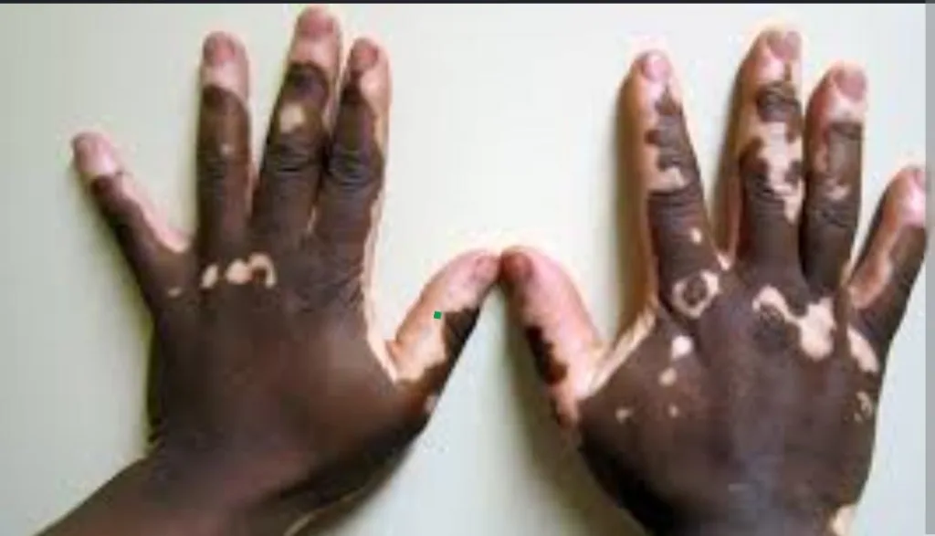 World Vitiligo Day: Dermatologist calls for greater awareness and an end to stigma