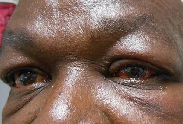 Apollo outbreak hits Sefwi Wiawso; health authorities issue public health alert