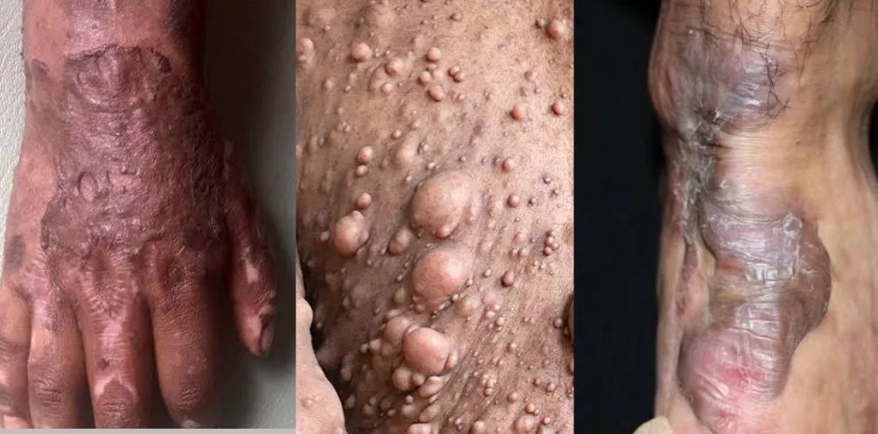 Patients with burns, scars and tumours to benefit from free reconstructive surgery screening at CCTH
