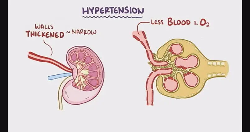 Health expert urges enough sleep, rest to control hypertension