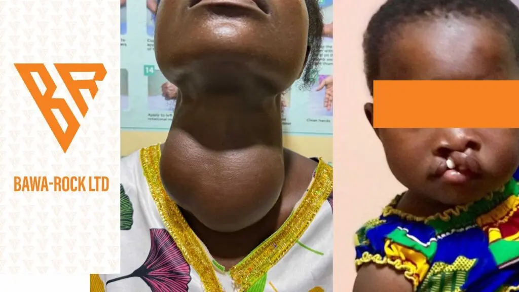 Bawa-Rock Ltd funds GH¢400,000 free surgeries for 102 vulnerable patients