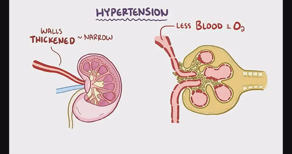 Hypertension cases rising in Ghana as many remain unaware of condition