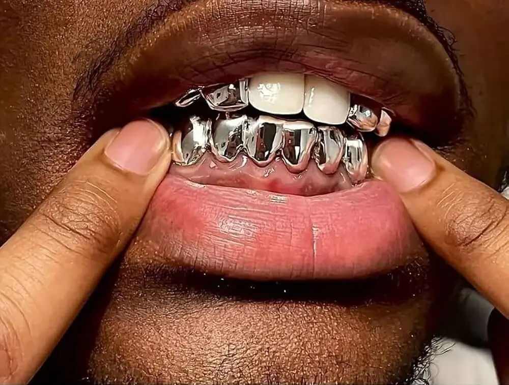 Fashion braces pose serious oral health risks—Dentist warns