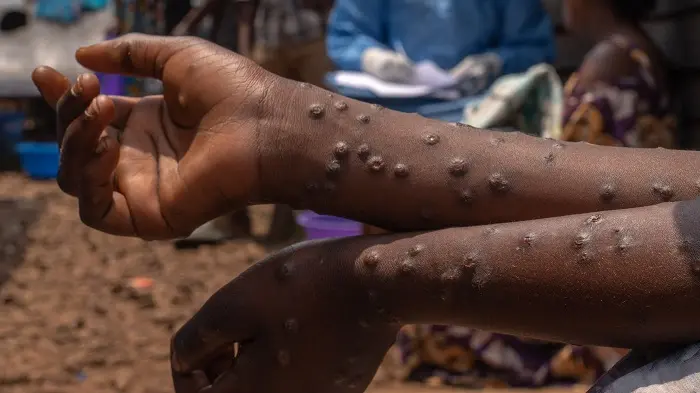 6 new Mpox cases, recorded in Ghana, total confirmed infections now 1,070 since outbreak