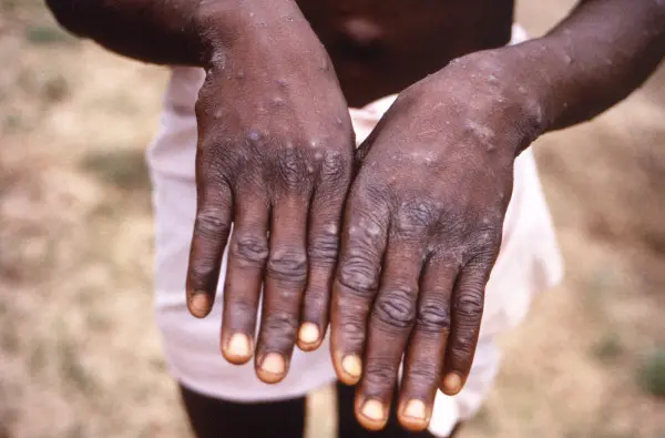 GHS confirms over 1000 cases of Mpox