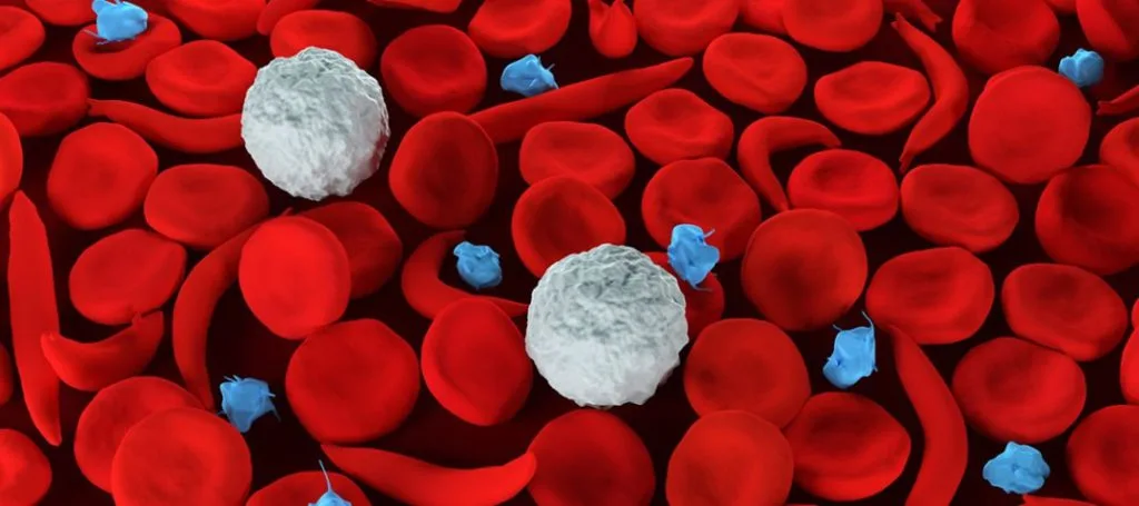 18,000 children born with sickle cell disease annually in Ghana – WHO