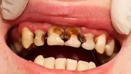 What if we could regrow our teeth, instead of filling?